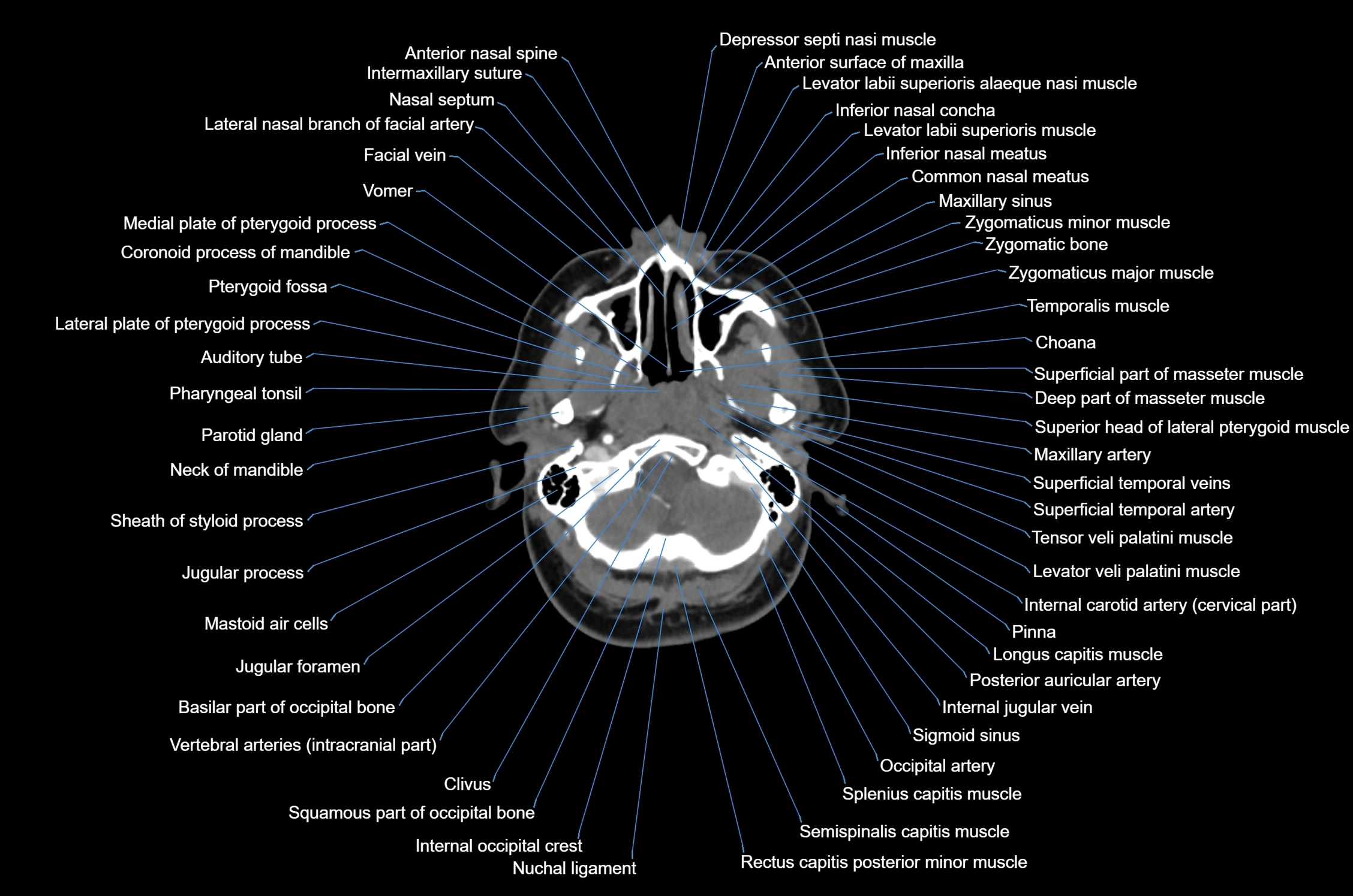 CT Neck axial cross sectional anatomy radiology image-img-00001-00018.webp